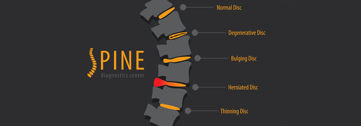 Chiropractic Herndon VA Disc